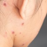 Cara Gampang Hilangkan Bekas Cacar Air Secara Alami