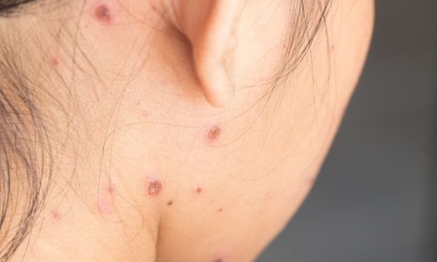 Cara Gampang Hilangkan Bekas Cacar Air Secara Alami