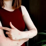 Kulit Mulus Lagi, Ini Cara Alami Usir Bekas Cacar Air